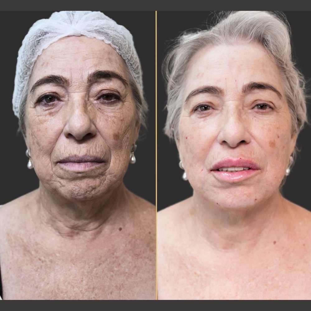 Antes e depois: Frente, antes e depois do protocolo.