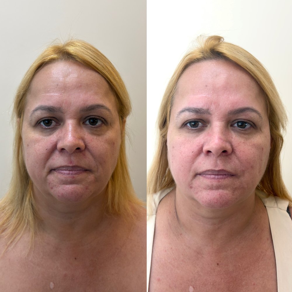 Antes e depois: Frente, antes e depois do protocolo.