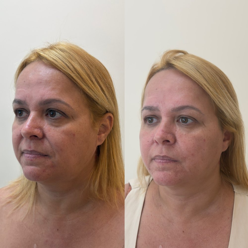 Antes e depois: Três quartos, antes e depois do protocolo.