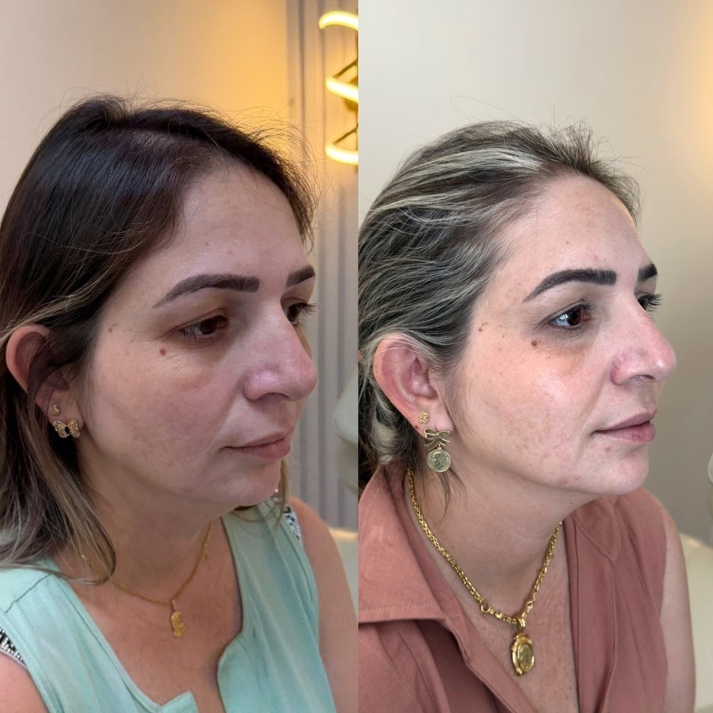 Antes e depois: Três quartos, antes e depois do protocolo.