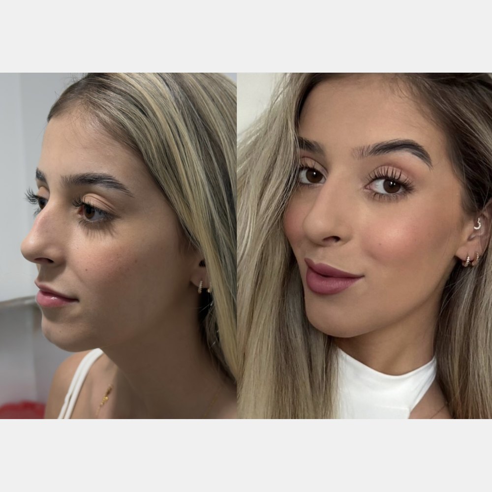 Antes e depois: Perfil e frente, antes e depois do protocolo.